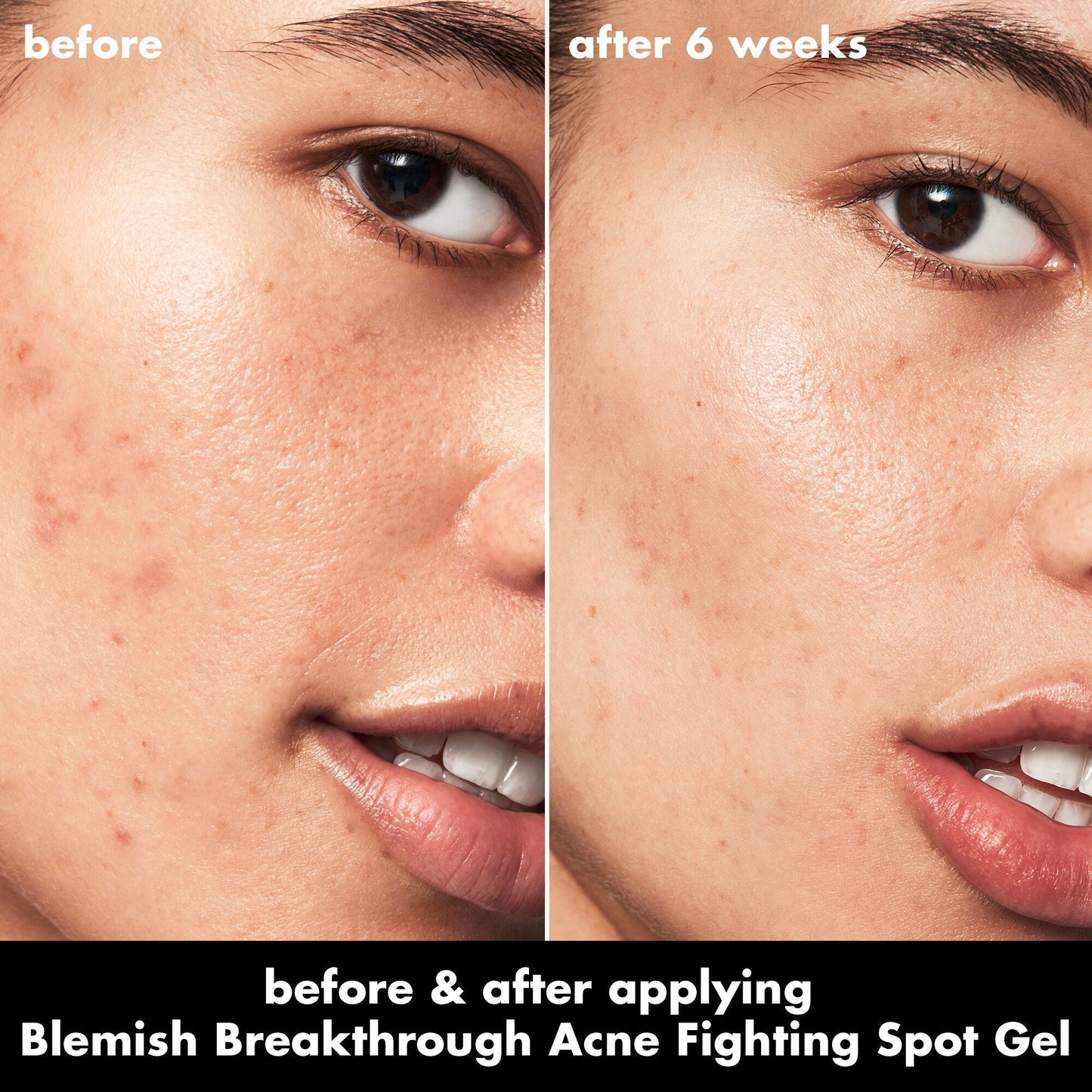 blemish-breakthrough-acne-fighting-spot-gel-c4 0326_EDU_BB_SpotGel_BA_ISABELLA.jpg