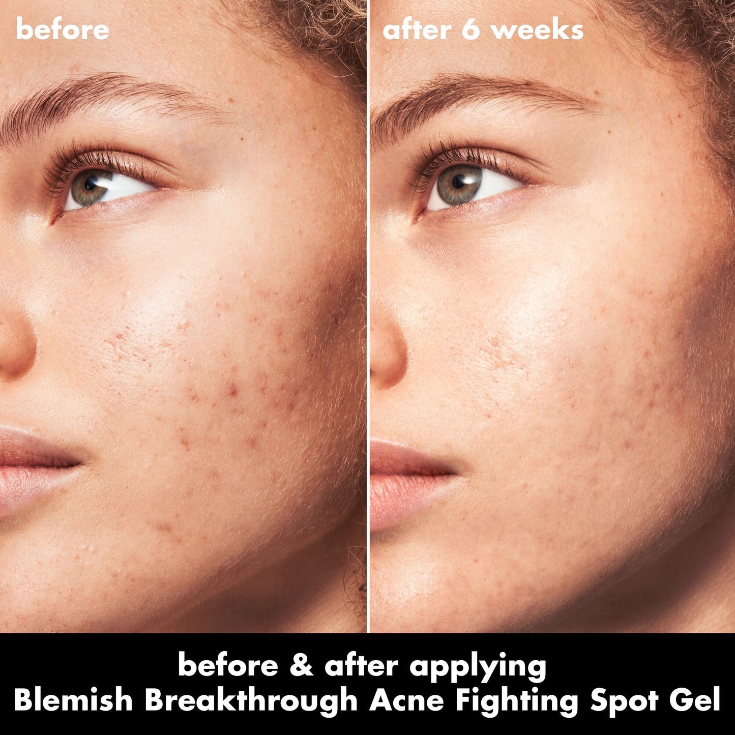 blemish-breakthrough-acne-fighting-spot-gel-c4 0326_EDU_BB_SpotGel_BA_MARLEY.jpg