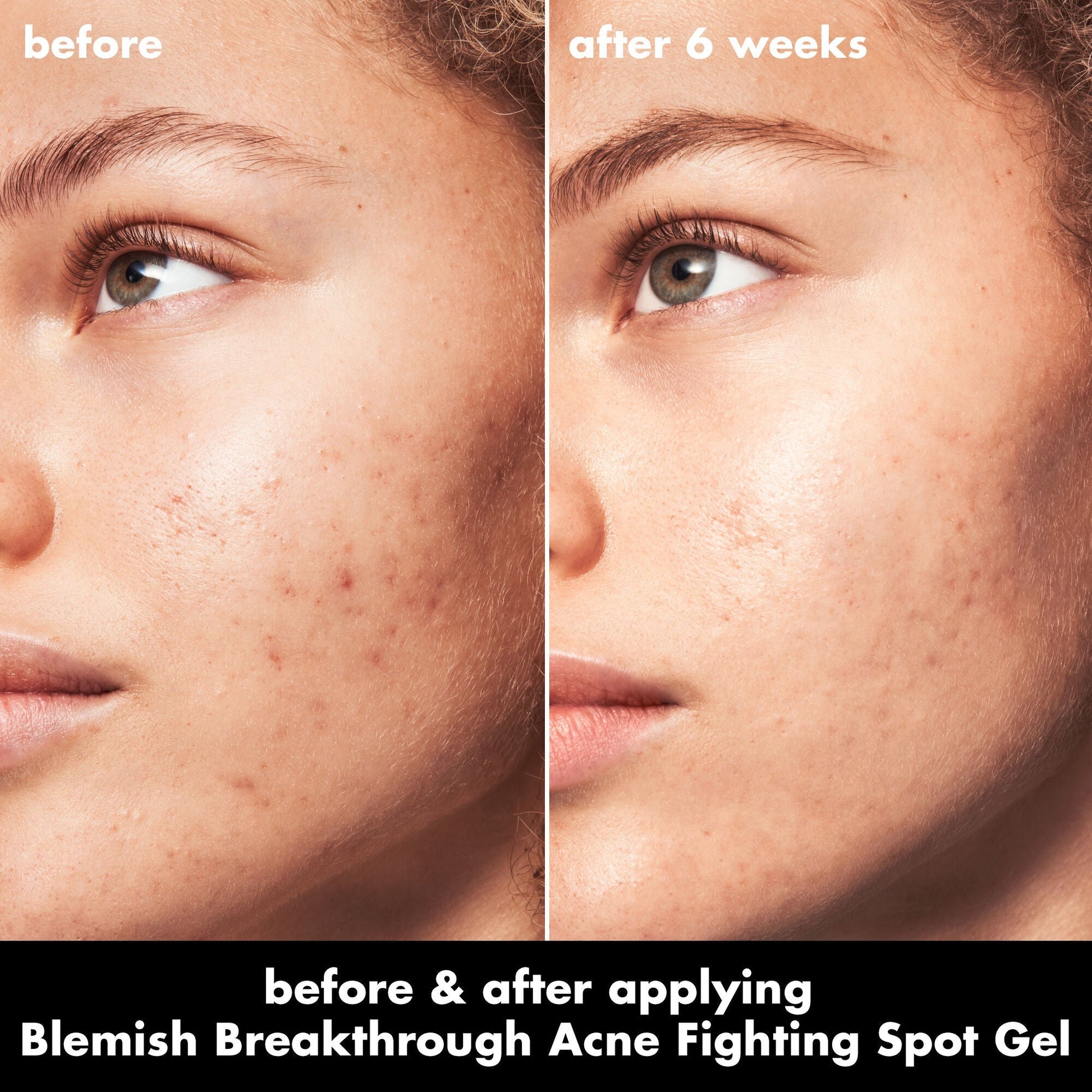 blemish-breakthrough-acne-fighting-spot-gel-c4 0326_EDU_BB_SpotGel_BA_MARLEY.jpg