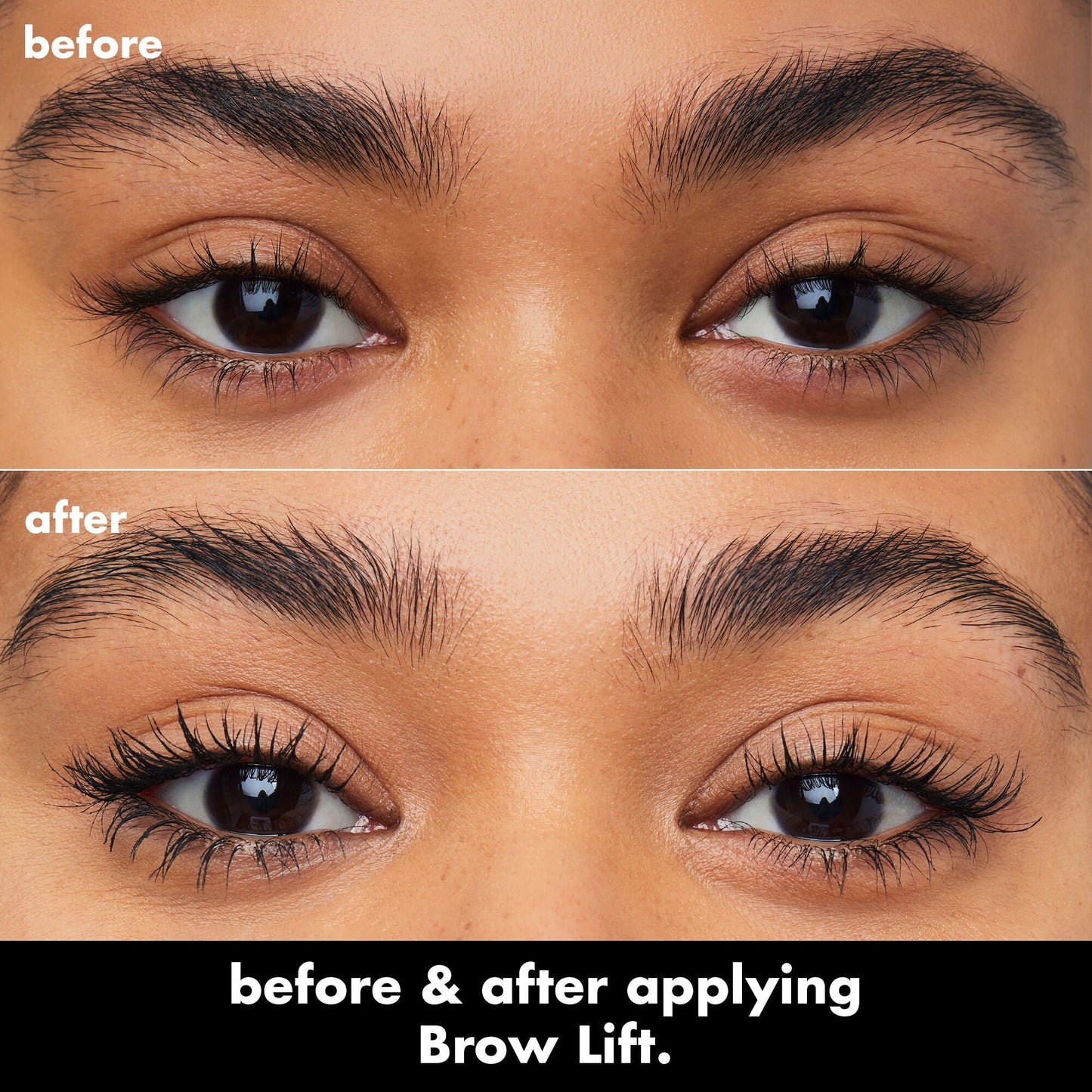 brow-lift-p1 0326_EDU_BrowLift_BA.jpg