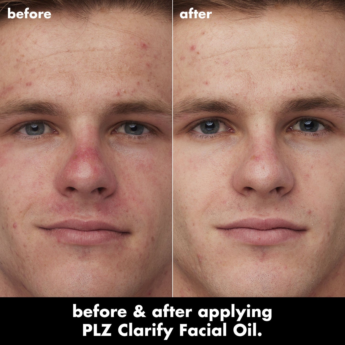 plz-clarify-facial-oil-q8 0326_EDU_PlzClarify_BA_Caleb.jpg