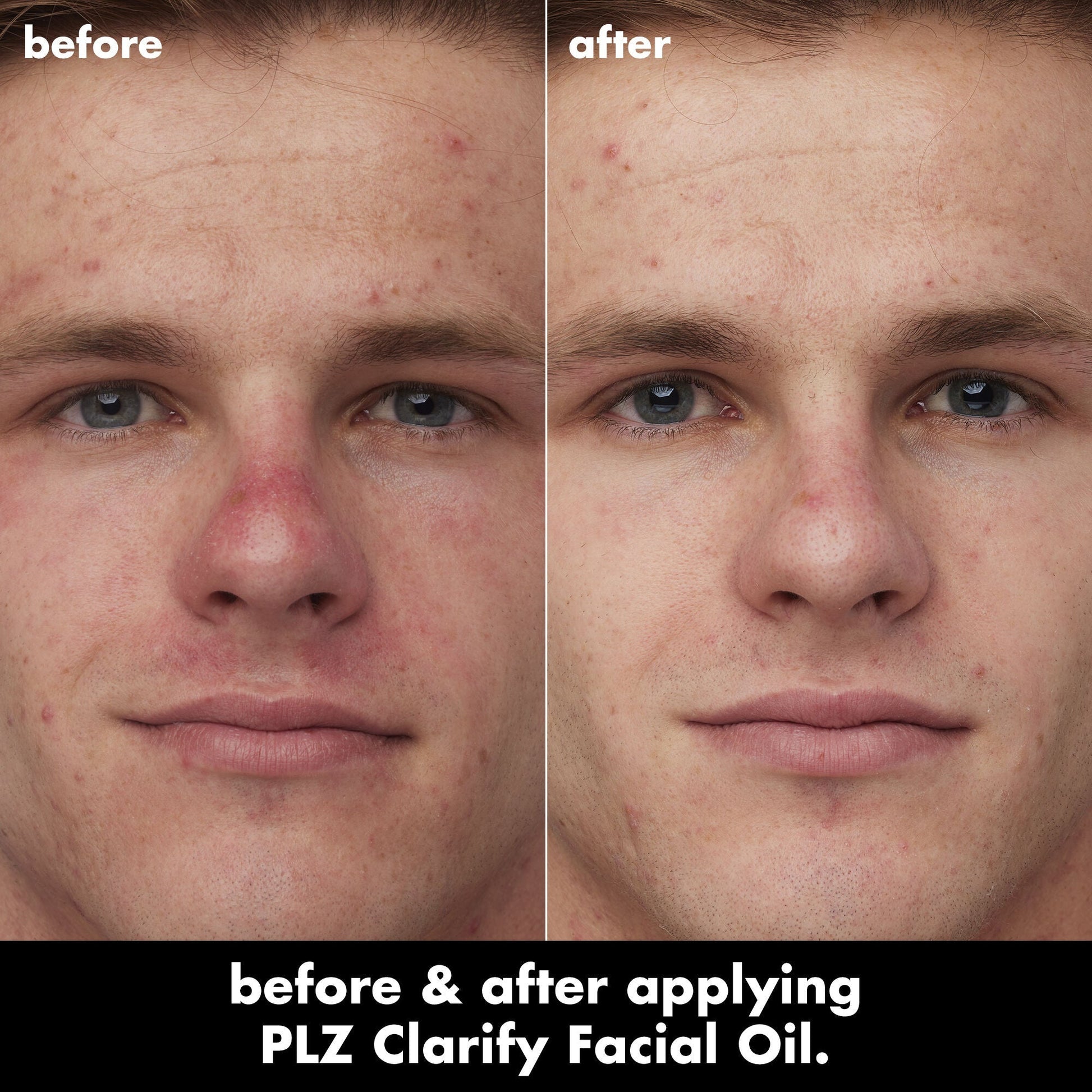 plz-clarify-facial-oil-q8 0326_EDU_PlzClarify_BA_Caleb.jpg