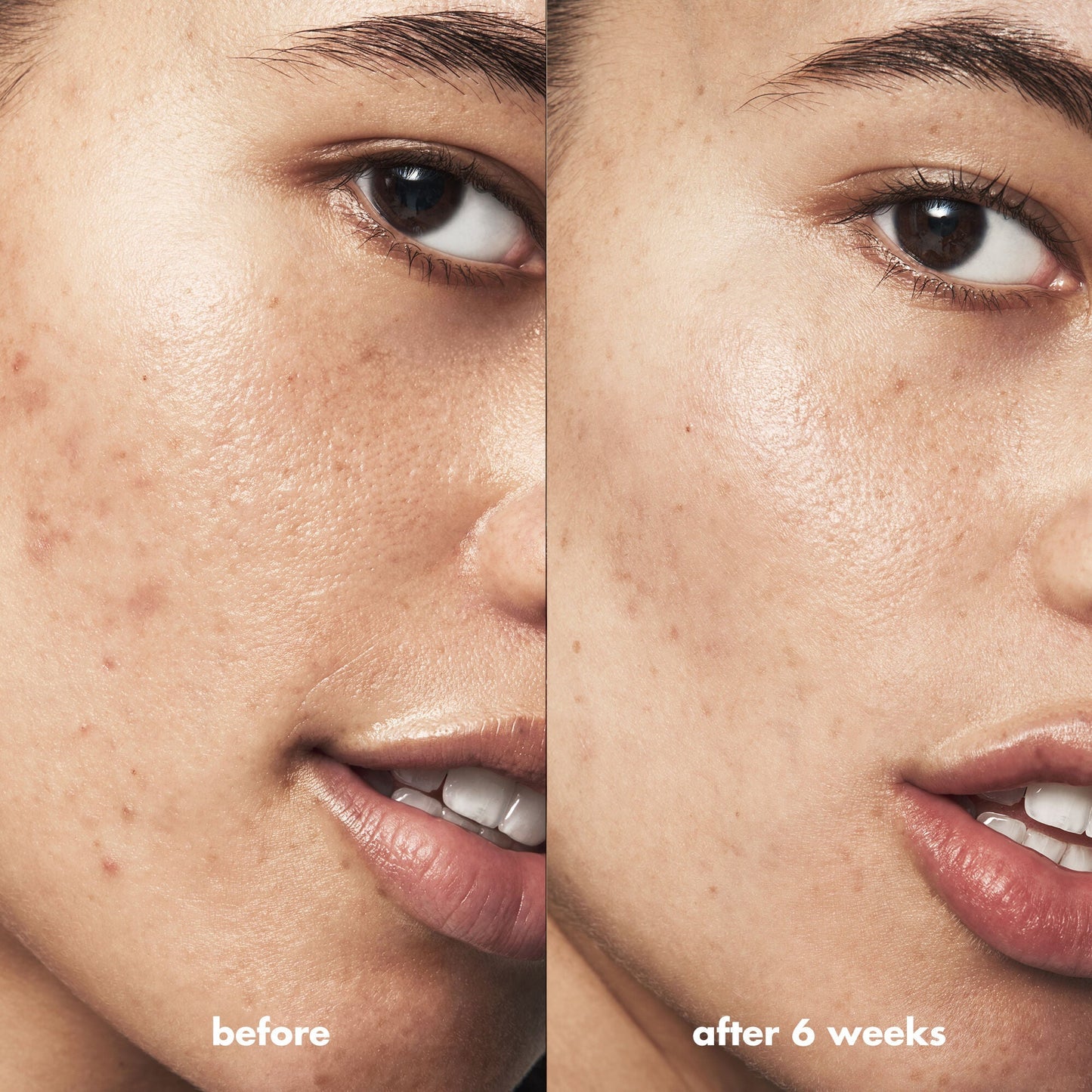 blemish-breakthrough-acne-clarifying-cleanser-x6 Acne_PDP_Isabella_Before_After_a3ff322b-cc6f-4b1a-9db3-bfb66c15d034.jpg