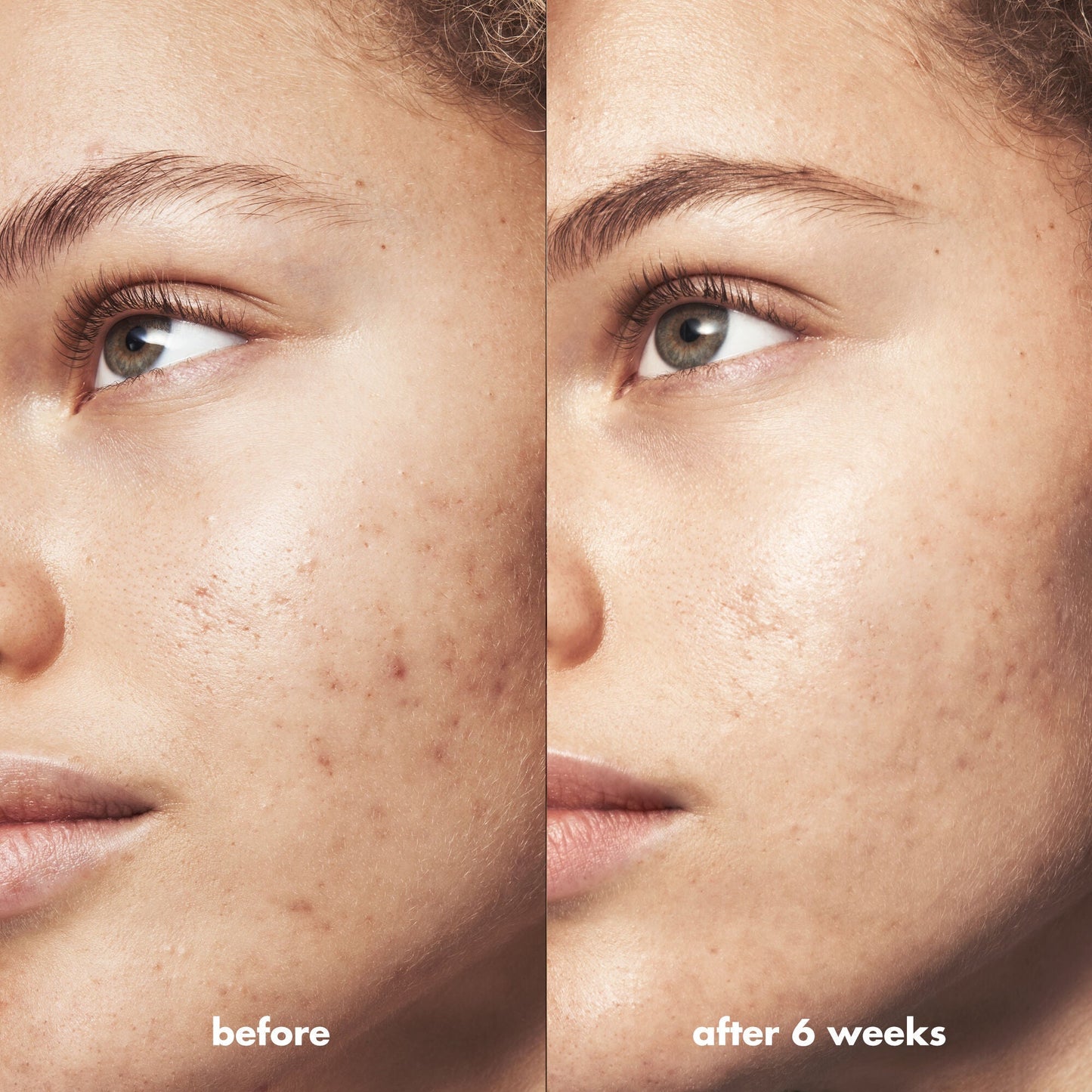 blemish-breakthrough-triple-acid-resurfacing-serum-a0 Acne_PDP_Marley_Before_After_1a95cac5-0af6-43b6-a936-d0bacbdec0bf.jpg